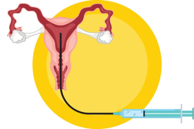 Intrauterine Insemination (IUI)