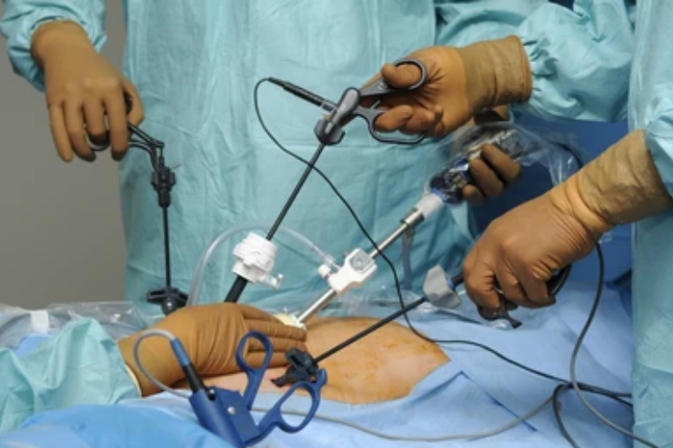 Laparoscopic hysterectomy-------19